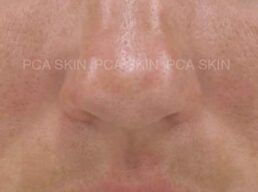 Close-up of smooth, clear pore skin with minimal imperfections for healthy complexion. {{brizy_dc_image_alt imageSrc=