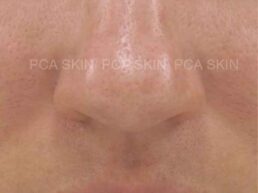 Close-up of smooth, clear skin with visible pores, showcasing skincare results. {{brizy_dc_image_alt imageSrc=